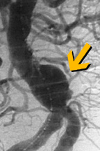 تمدد وعائي.jpg