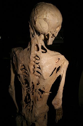 ملف:Fibrodysplasia ossificans progressiva.jpg