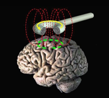 ملف:Transcranial magnetic stimulation.jpg