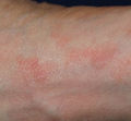 Acarodermatitis Fuß.jpg