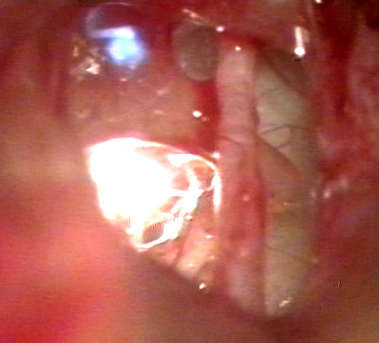 ملف:Stapes laser2.jpg