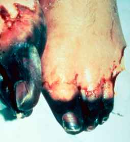 تغير الجلد في مناطق النزف نتيجة الإصابة بمرض الطاعون