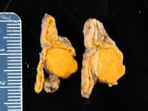 Adrenal gland Conn syndrome4.jpg