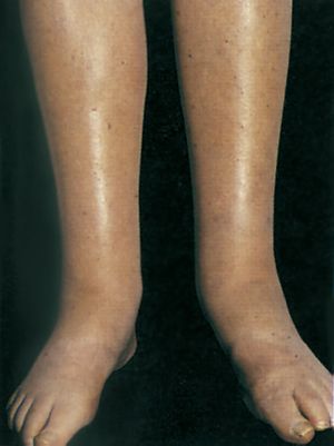 وذمات في الطرفين السفليين.jpg