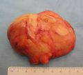 The resected lipoma (8 cm × 6 cm × 3 cm)
