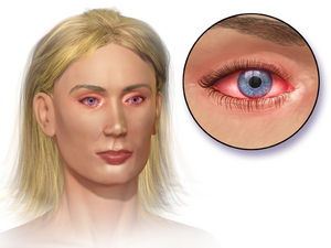 Blausen 0013 AllergicConjunctivitis.png