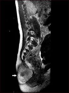 Sacrococcygeal teratoma.jpg