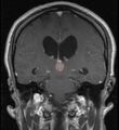 Tumor Pineocytoma2.JPG