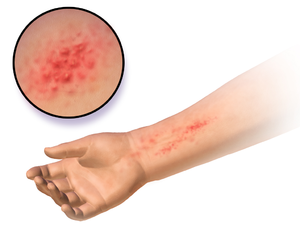Blausen 0014 AllergicDermatitis.png