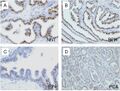 Microscopic examination of different types of prostate tissues (stained with immuno­histochemical techniques): A. Normal (non-neoplastic) prostatic tissue (NNT). B. Benign prostatic hyperplasia. C. High-grade prostatic intraepithelial neoplasia. D. Prostatic adenocarcinoma (PCA).
