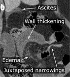 CT scan of a small bowel volvulus. It shows two juxtaposed segments of narrowing, which is the spot of mesentery rotation. The other signs indicate strangulation.