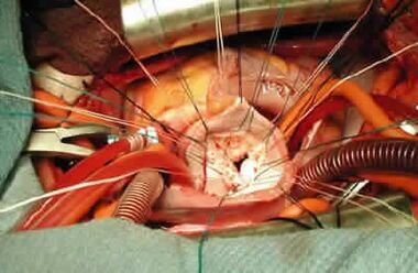 Mitral valve replacement.jpg