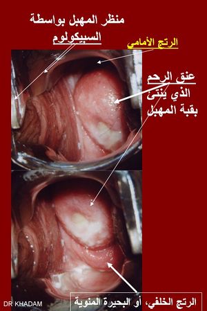 صورةالتقطت بواسطة منظار الرحم تبين الإفرازات المهبلية البيضاء الطبيعية والتي تتوضع على عنق الرحم وعلى جدار المهبل.