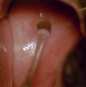 صورة توضح إفرازات المهبل عند الإثارة