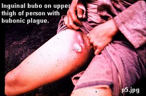 Plague -bubos.jpg