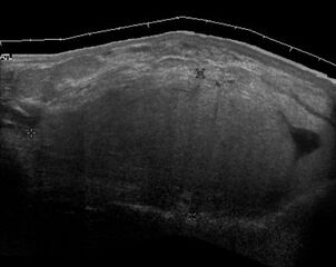 Ultrasonography of a liposarcoma mimicking a lipoma. A homogeneous hypoechoic mass presenting with the same appearance of lipoma. It was clinically distinguished as having rapid growth.[5]