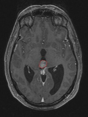 Tumor Pineocytoma1.JPG