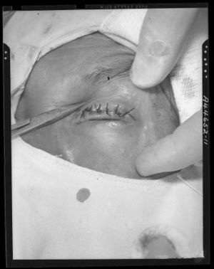 Entropion and trichiasis secondary to trachoma A44-652-11.jpg