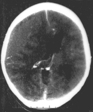 Epidural hematoma.png