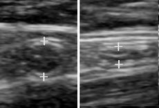 A normal appendix without and with compression. Absence of comprehensibility indicates appendicitis.[4]