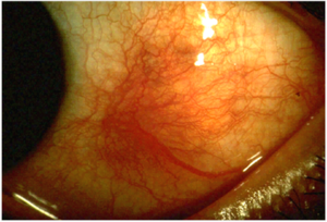 In this picture, the eyeball shows a large red inflamed spot on its sclera, a symptom of scleritis, just left of the iris.
