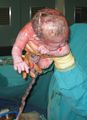 Newborn child, soon after birth by Caesarian section.