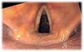 Endoscopic image of larynx seen at the time of intubation of the esophagus during gastroscopy.