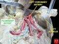 Left coronary artery