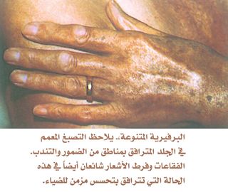 البرفيرية المتنوعة.jpg