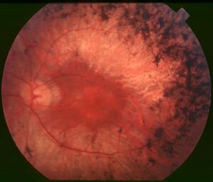 Fundus of patient with retinitis pigmentosa, mid stage.jpg