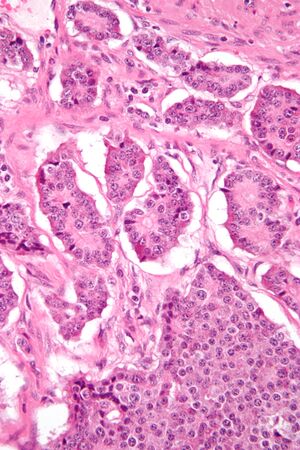 Small intestine neuroendocrine tumour high mag.jpg