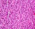 Plasmacytoma. H&E stain.