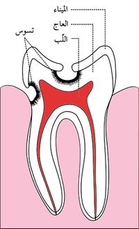 شكل2 نخر الأسنان.jpg