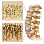 التجاويف الناشئة عن هشاشة العظام