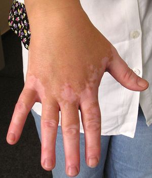 Vitiligo03.jpg