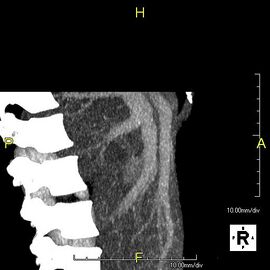 منظر جانبي بإسقاط الشدة القصوى لنفس المريض كما في الصورة السابقة.