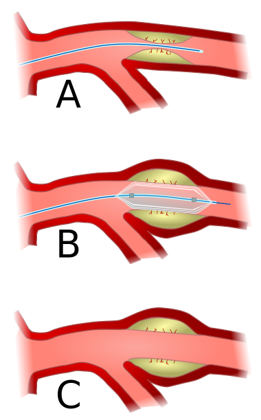 Angioplasty-scheme.svg