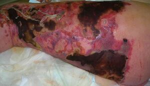 Necrotizing fasciitis left leg.JPEG