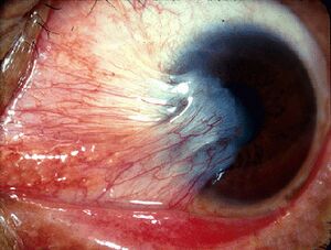 Pterygium (from Michigan Uni site, CC-BY).jpg