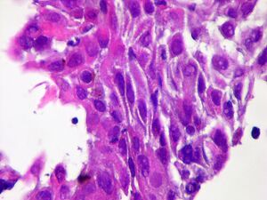 Squamous cell carcinoma 4.jpg