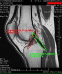 Cruciate ligaments
