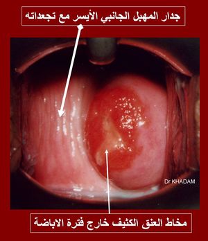 صورةالتقطت بواسطة منظار الرحم تبين تجعدات جدار المهبل بعد إزالة الإفرازات المهبلية عنه.