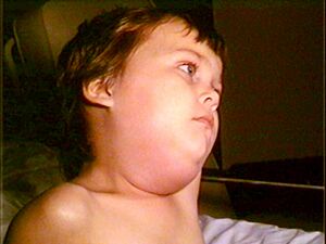 Mumps PHIL 130 lores.jpg