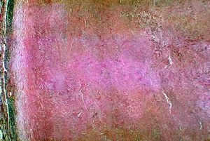 Coccidioidomycosis 01.jpg