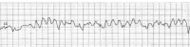 EKG VF.jpg