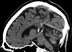 Verkalkte Corpus pineale Zyste sagittal.jpg