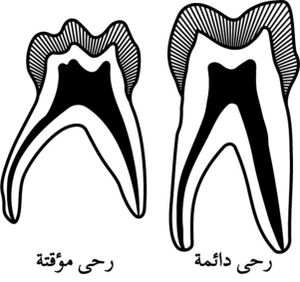 الرحى الدائمة والمؤقتة.