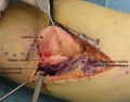Intraoperative photo.