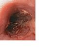Herpes esophagitis.JPG