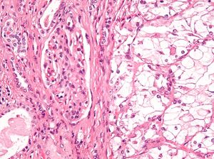 Clear cell renal cell carcinoma high mag cropped.jpg